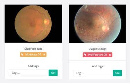 Behold.ai  的软件为显示糖尿病视网膜病变（这是全球导致失明的主要原因之一）的影像添加了标记。