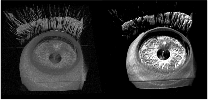  前眼部の従来のレンダリング（左）と、レイキャスティングの画質を上げノイズ除去したもの（右）の比較 