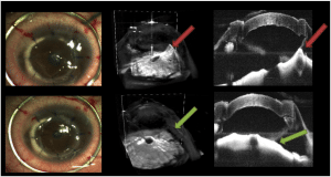 全層角膜移植での虹彩の異常癒着の分離。上の行は、異常な虹彩の癒着（赤色の矢印）を、手術用顕微鏡を通じて正面から見た通常の手術画像（左）、容積測定OCT（中央）、断面スキャン（右）。下の行は、粘弾性の物質を注入して異常な癒着（緑色の矢印）を分離する手術を行った結果。 