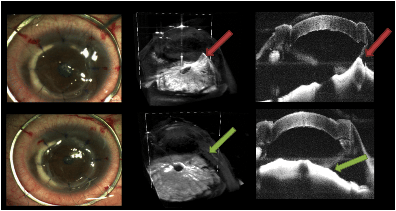 Resolution of abnormal iris adhesion in full thickness corneal transplant. The top row shows the abnormal iris adhesion (red arrow) in the normal en-face surgical view seen through the operating microscope (left), volumetric OCT (middle), and cross sectional scan (left). The bottom row shows the result of the surgeon injecting a viscoelastic material to resolve the abnormal adhesion (green arrow).