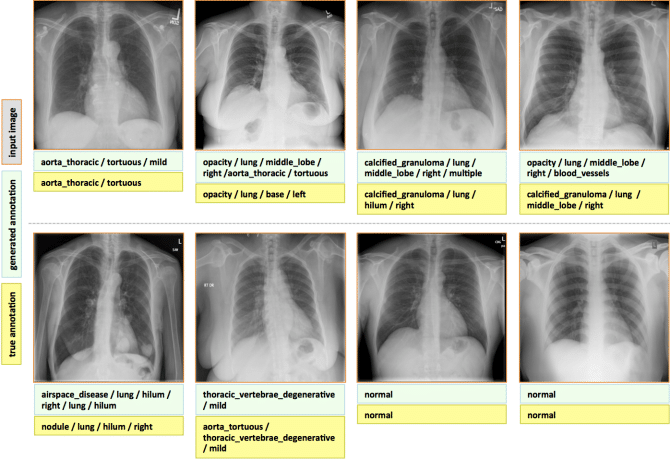 how-deep-learning-can-use-chest-x-rays-to-detect-disease-early-nvidia