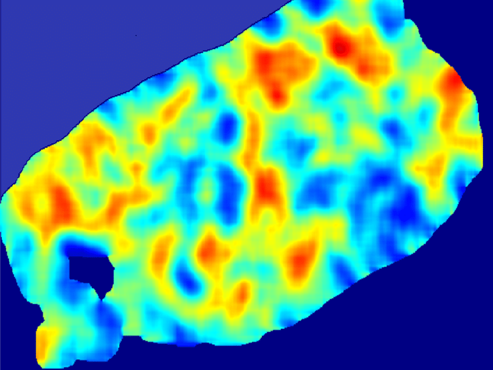 This "heat map" shows regions in the biopsy slide where the algorithms indicated a high likelihood of HER2-positive cancer. 