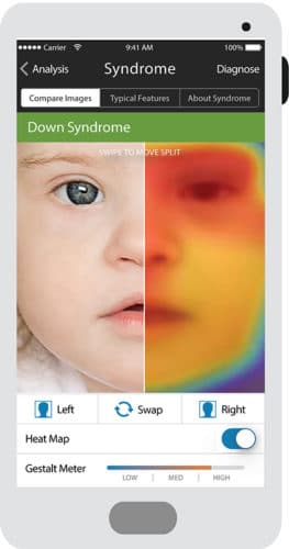 FDNA Face2Gene app analysis