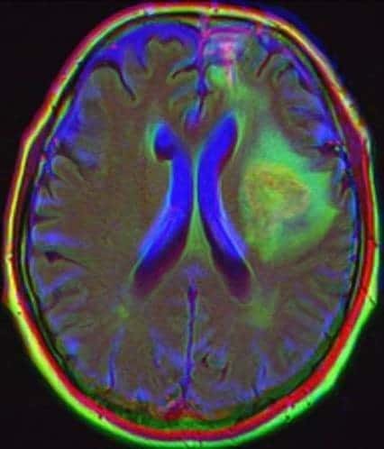 By using AI to predict brain tumor genomics from MRIs like these, the Mayo Clinic could forecast tumor growth and whether it will respond to certain treatments.
