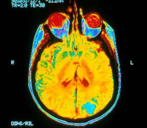 Mayo Clinic Taps AI to Predict Brain Tumor Genomics and Improve Treatment