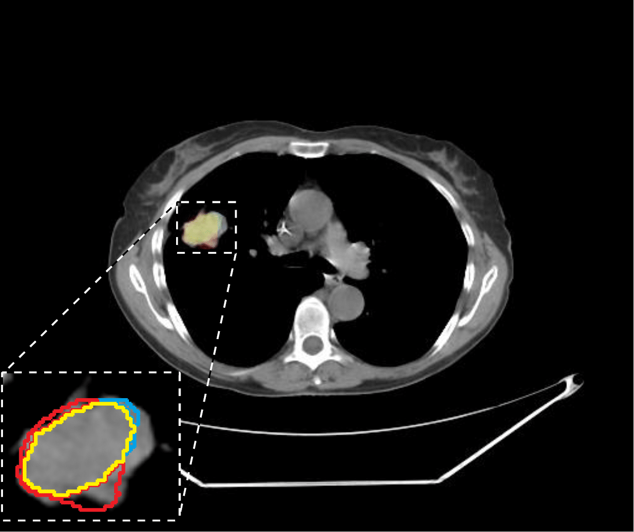 Would A Ct Scan Detect Stomach Cancer