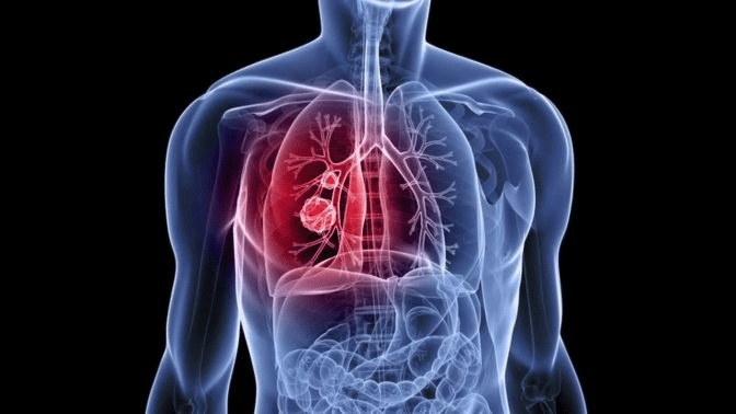 mesothelioma caused by all types of asbestos