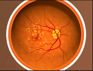 Eye showing advanced macular degeneration.