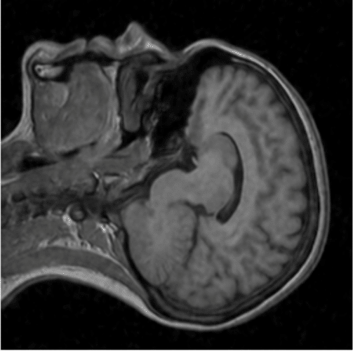 Ordinary AI denoising requires matched pairs of clean and dirty images. But it's often impossible to get clean images for MRIs and some other medical images. With Noise2Noise, no clean images are necessary. 