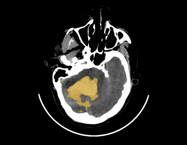 Qure.ai's automated CT scan identified this hemorrhage in the functional tissue of the brain.