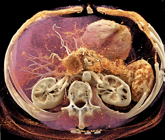  The pancreas, a fish-shaped organ, is pictured here in golden brown, above the kidneys and below the spleen. The dark circle at the center of the image is a tumor. Image courtesy of Dr. Elliot Fishman, Johns Hopkins Hospital.