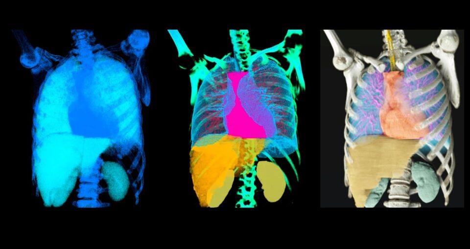 NVIDIA AI in radiology