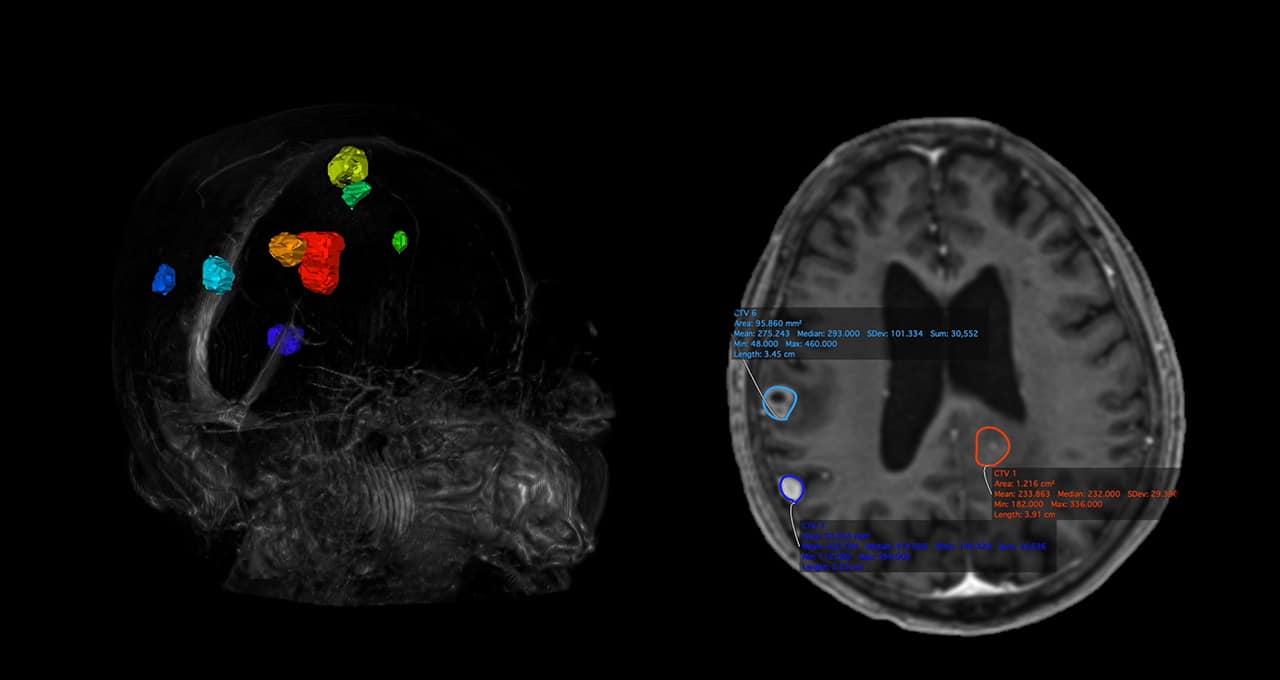 AI contouring for precision radiation