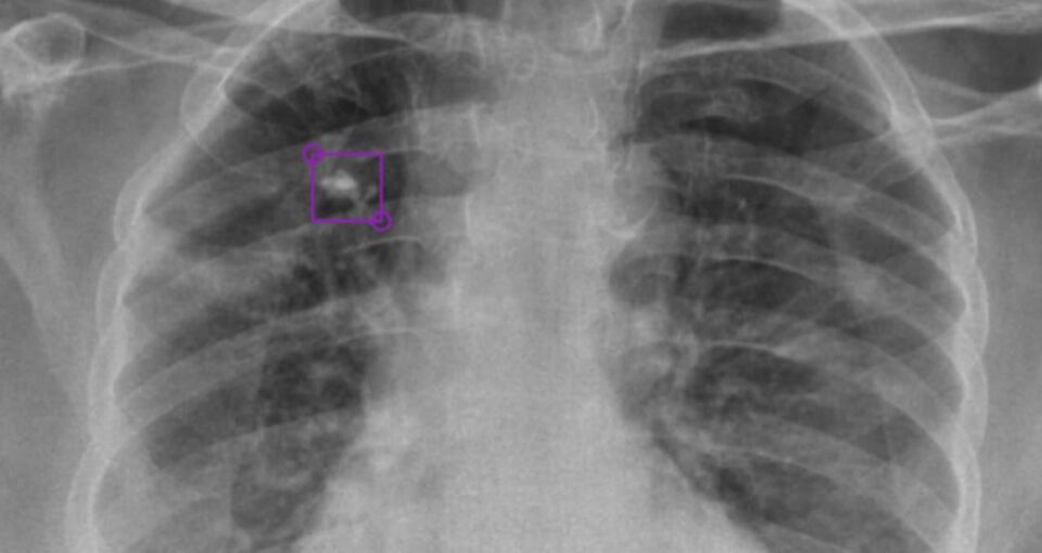 AI-annotated TB X-ray