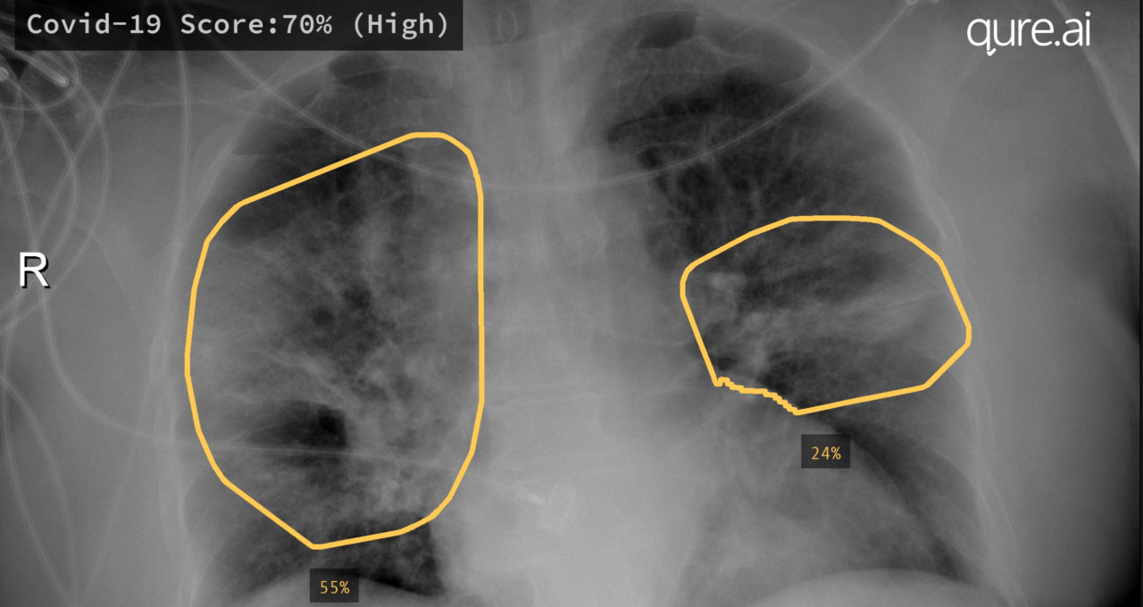 AI-labeled COVID lung scan