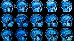 Keeping an AI on MRIs: Industry Experts Share Latest on AI and Machine Learning in Medical Imaging