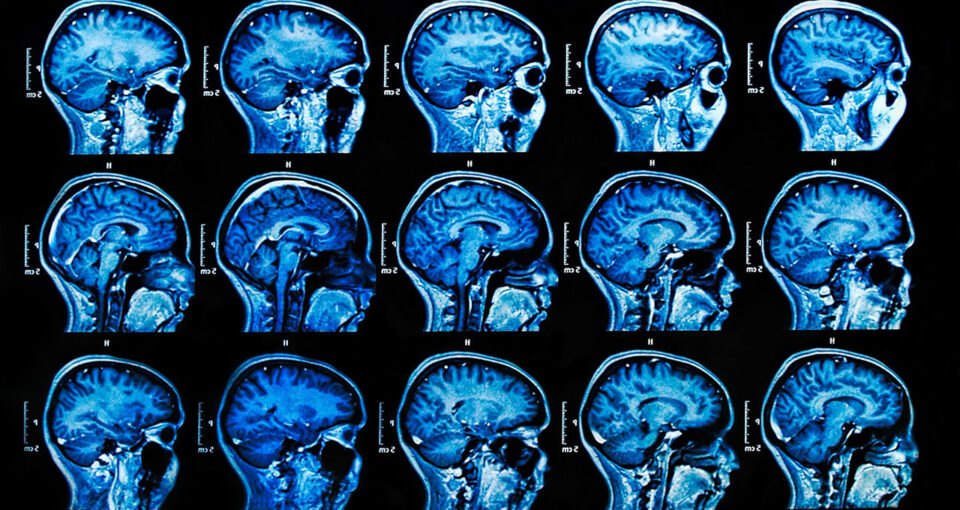 brain MRI scans