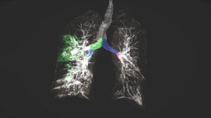 Medical AI Needs Federated Learning, So Will Every Industry