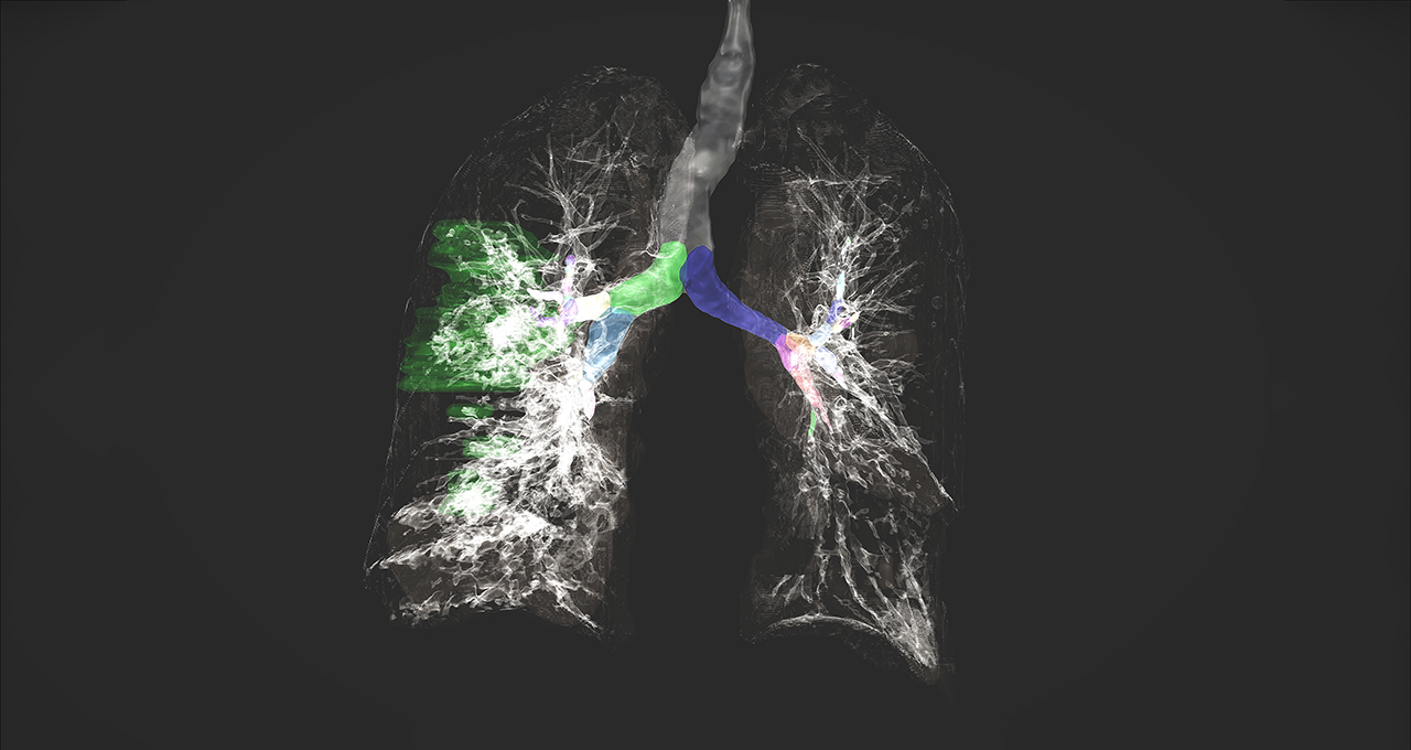 Medical AI Needs Federated Learning, So Will Every Industry