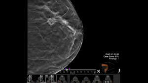 NVIDIA AI Enterprise Helps Researchers, Hospitals Targeting Cancer Hit the Mark