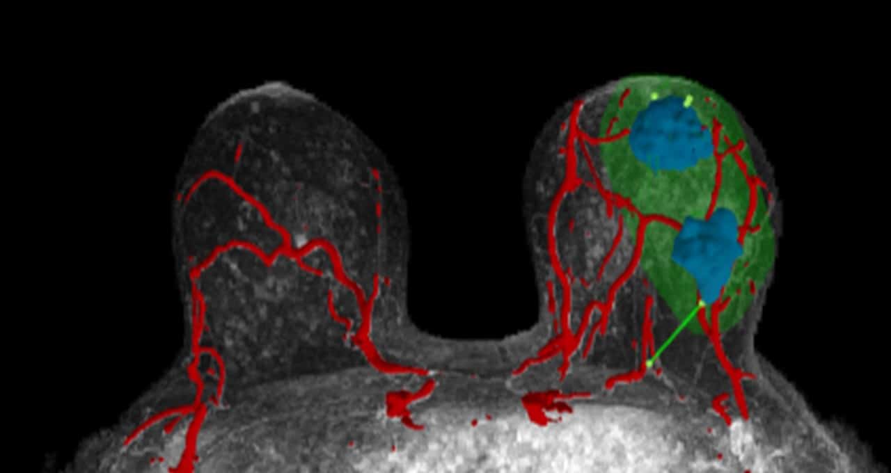 SimBioSys Helps Surgeons Goal Breast Cancers